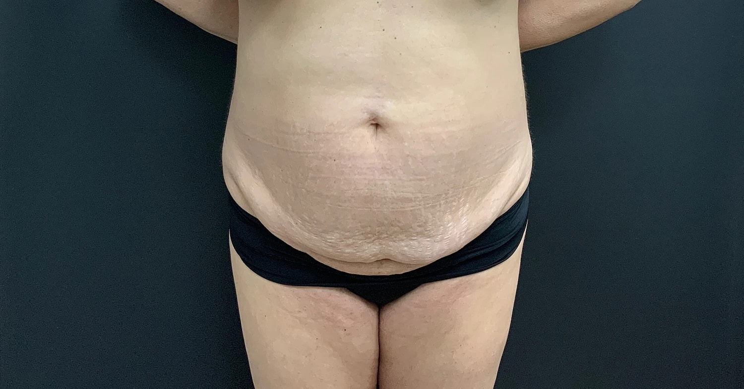 Post Weight Loss Before & After