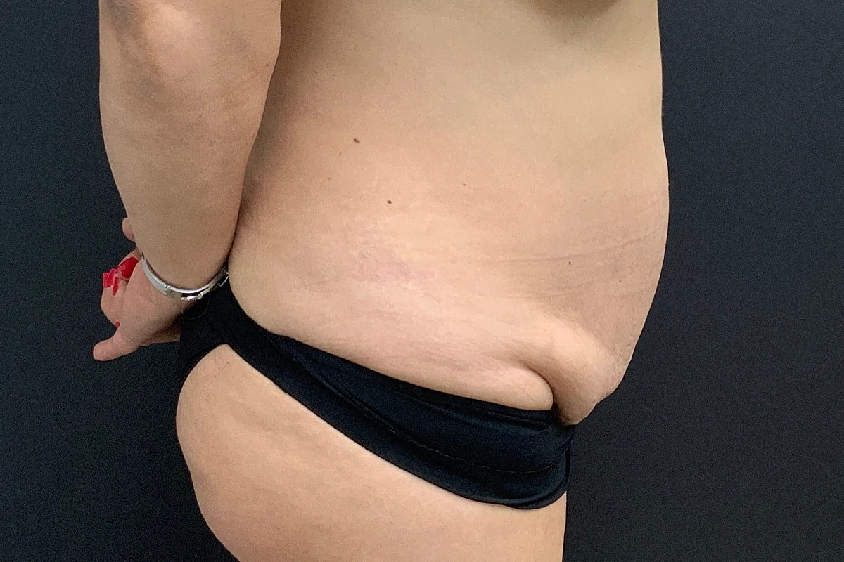 Post Weight Loss Before & After