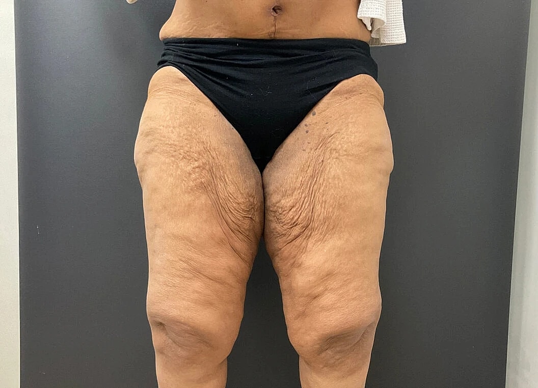 Post Weight Loss Before & After