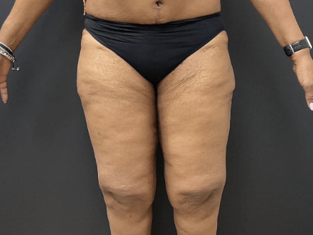 Post Weight Loss Before & After