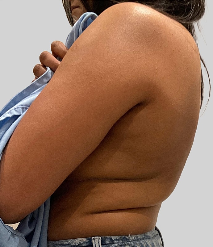 Post Weight Loss Before & After