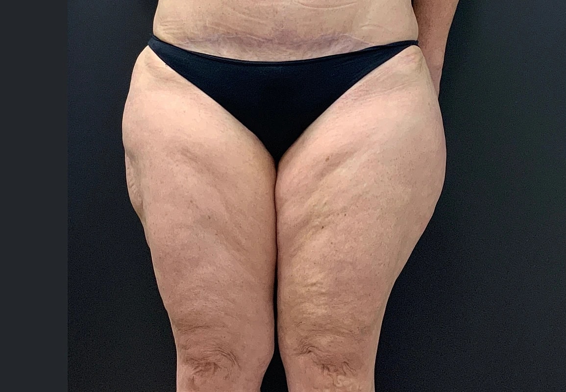 Post Weight Loss Before & After
