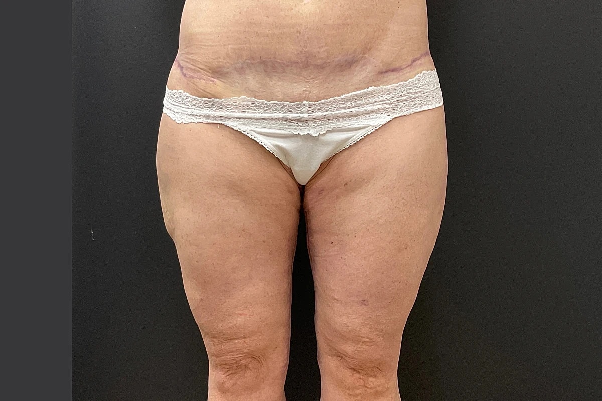 Post Weight Loss Before & After