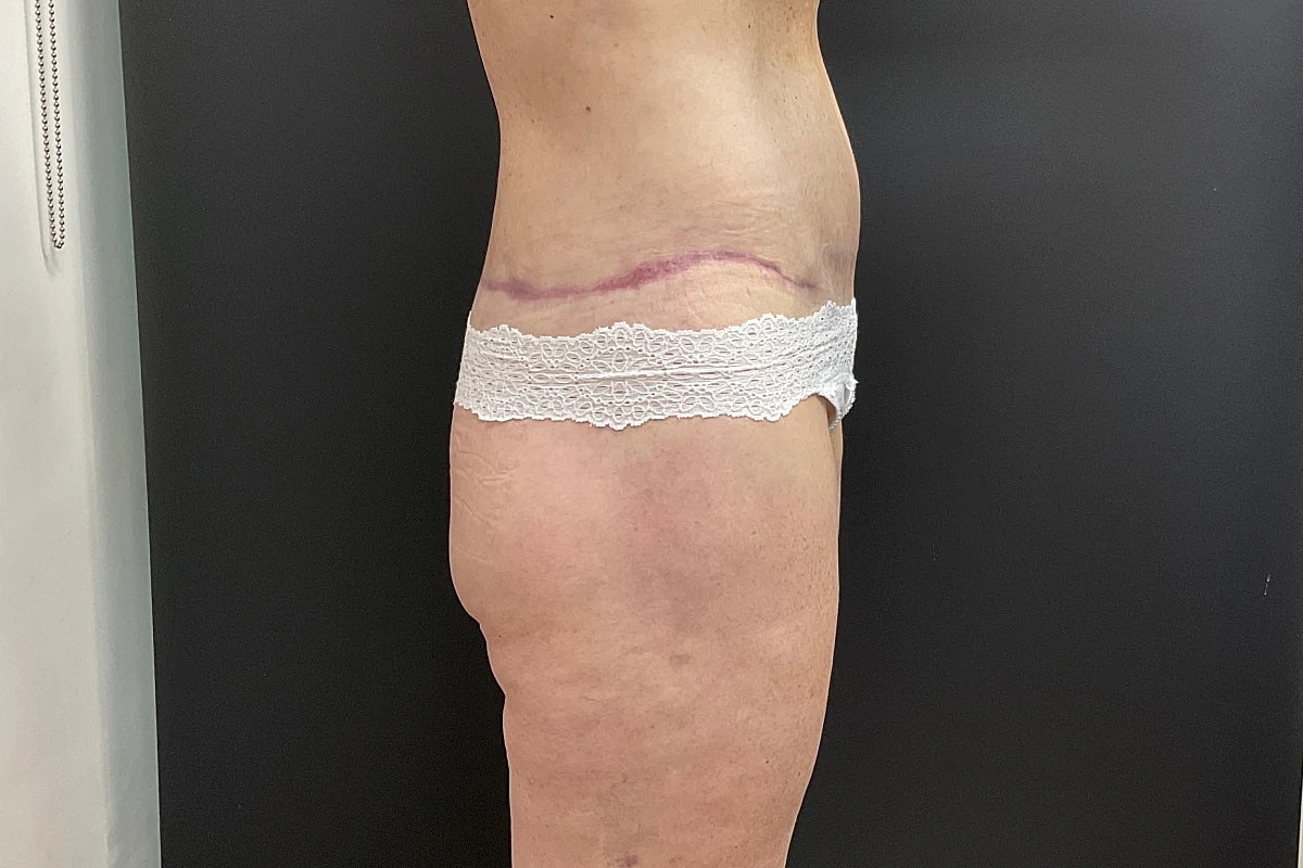 Post Weight Loss Before & After