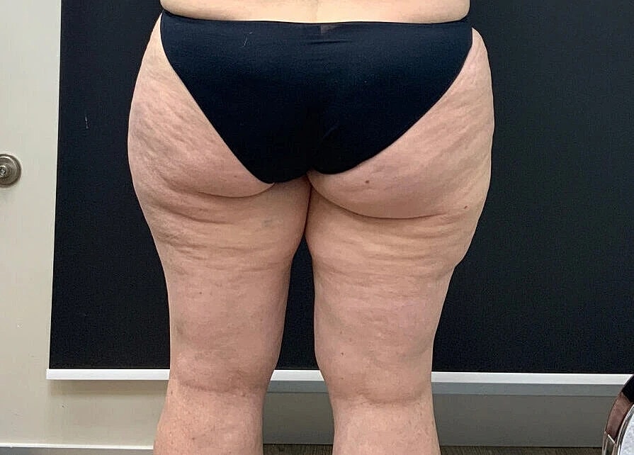 Post Weight Loss Before & After