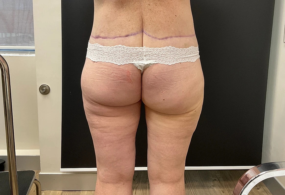 Post Weight Loss Before & After