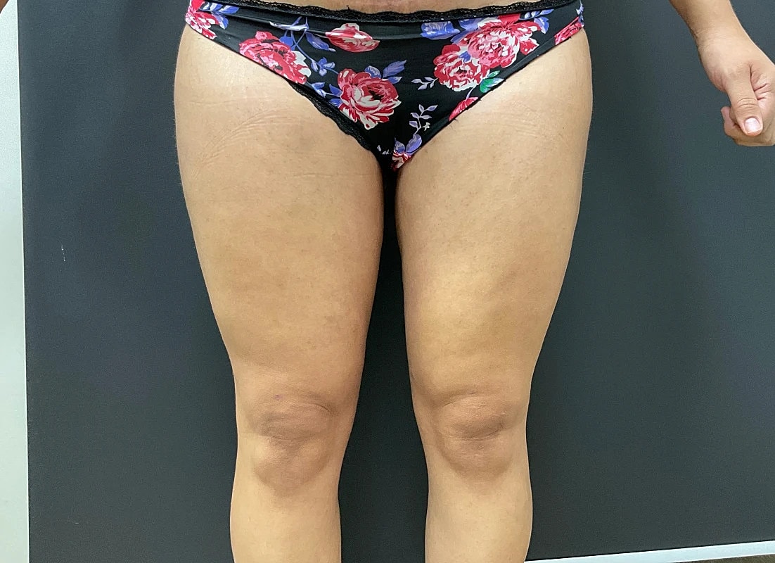 Post Weight Loss Before & After