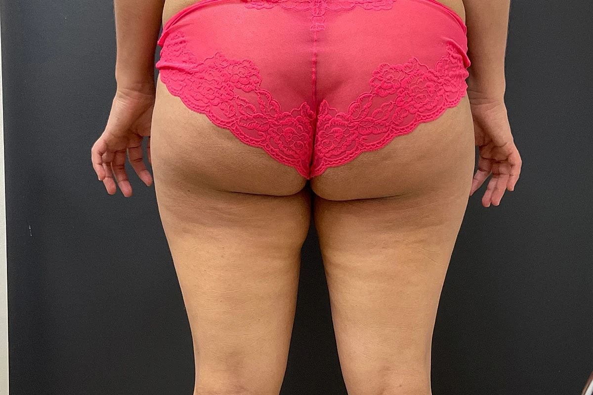 Post Weight Loss Before & After