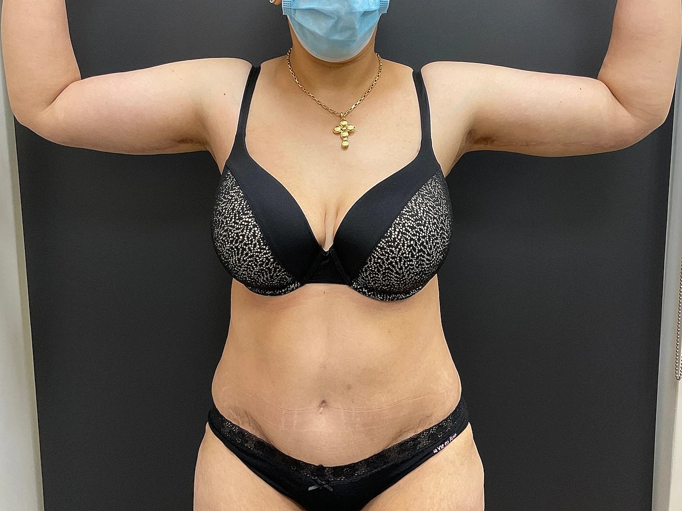 Post Weight Loss Before & After