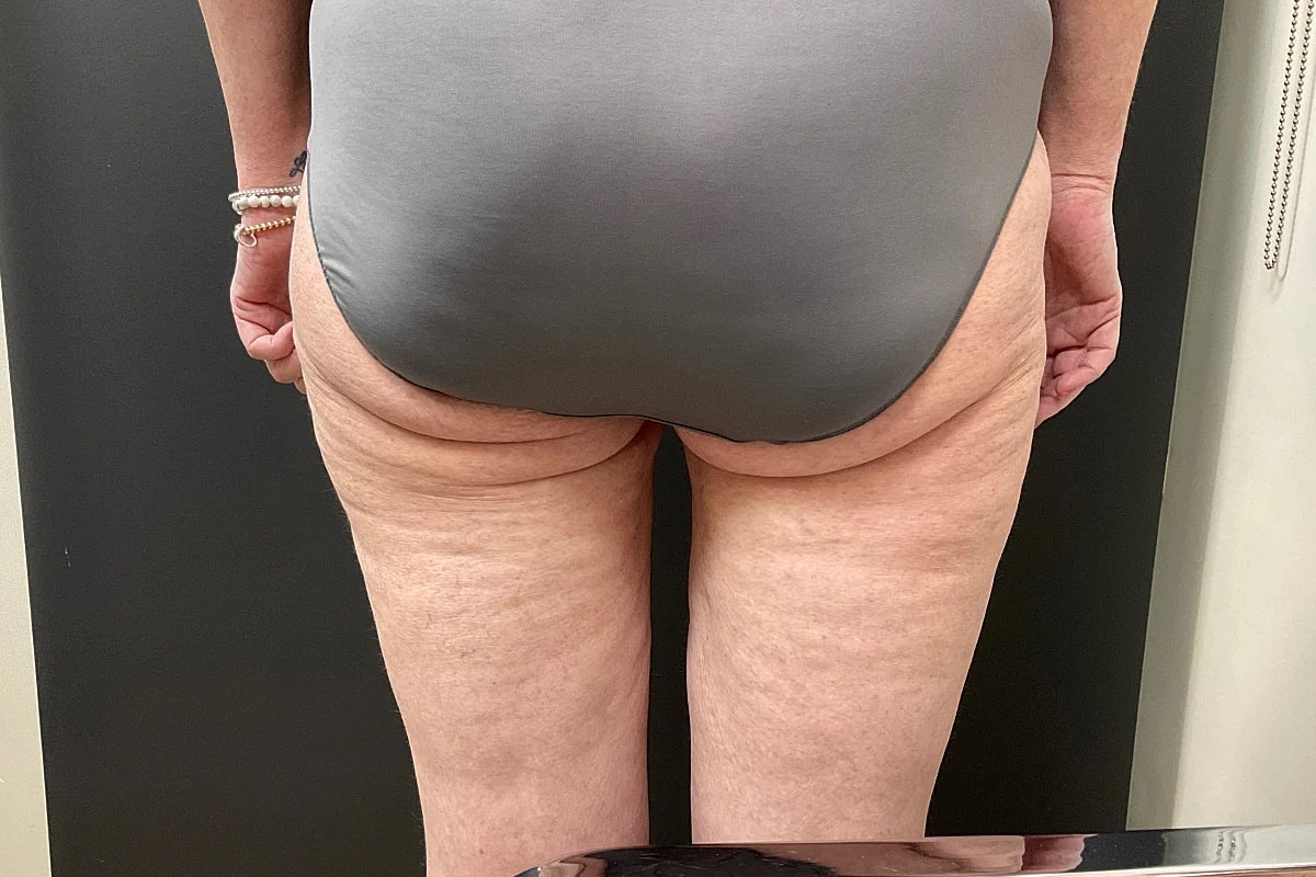 Post Weight Loss Before & After