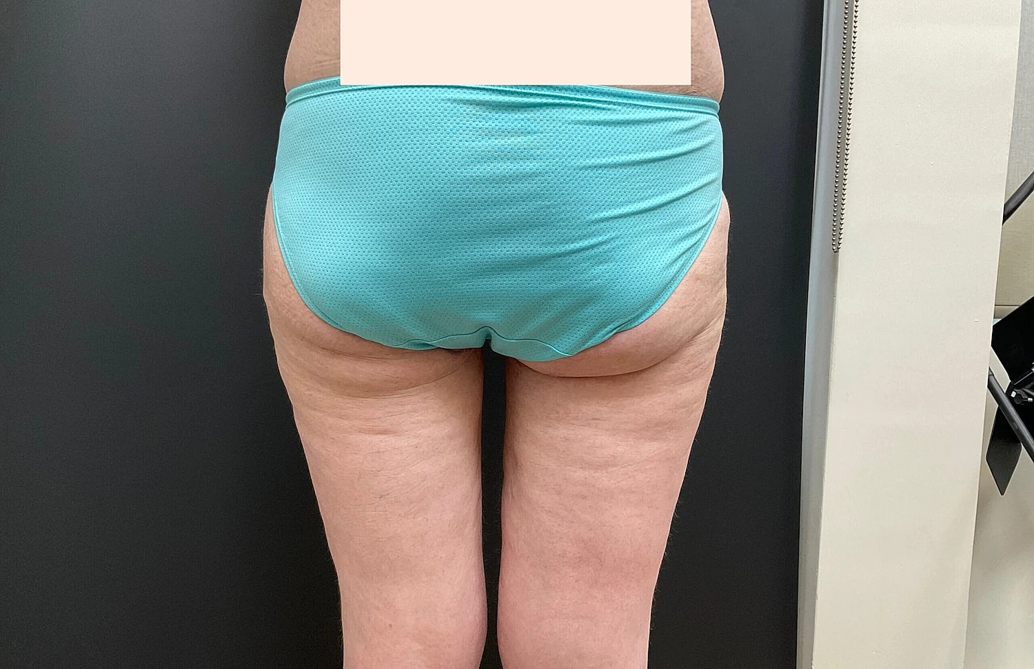 Post Weight Loss Before & After