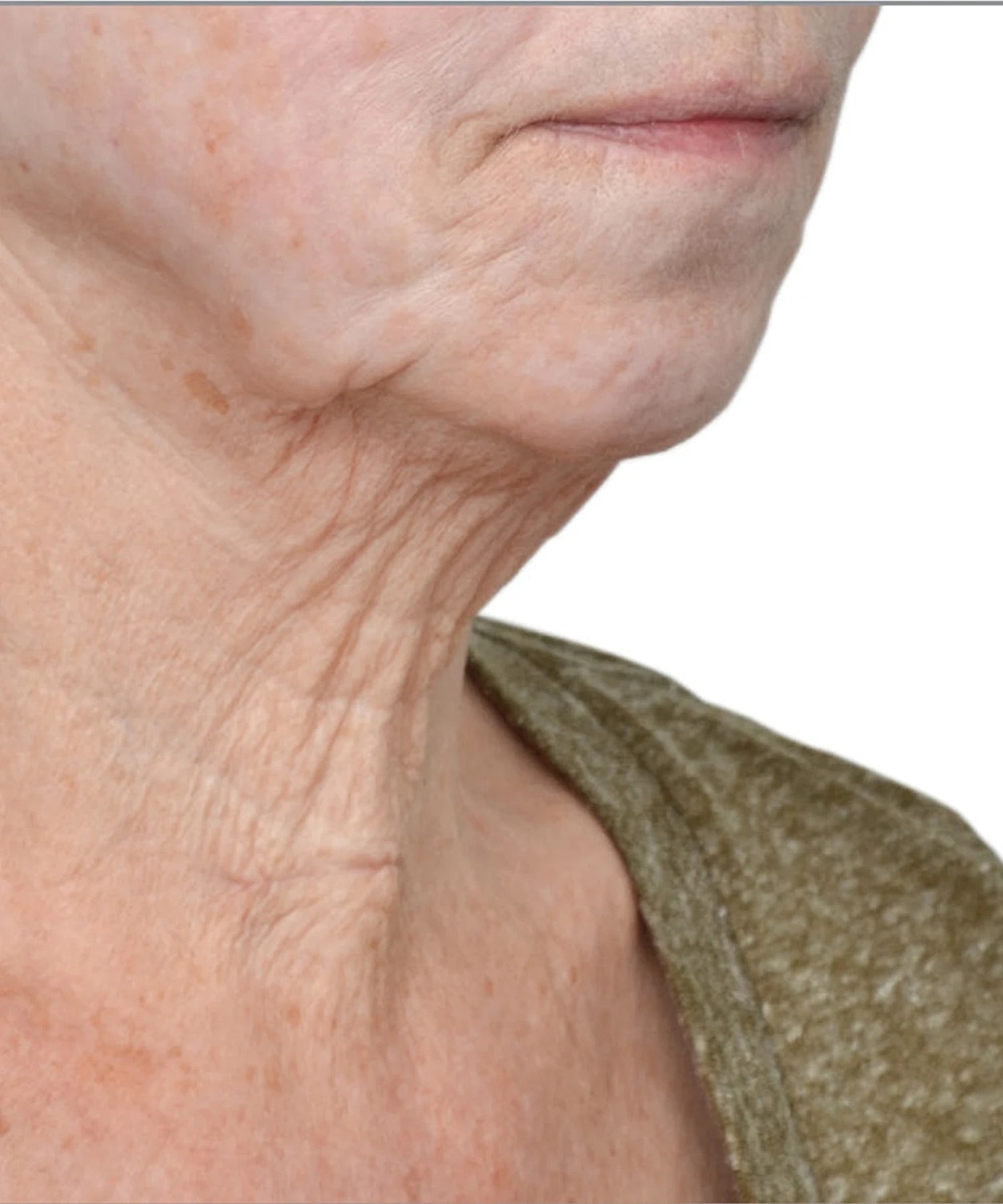 Skin Tightening Before & After
