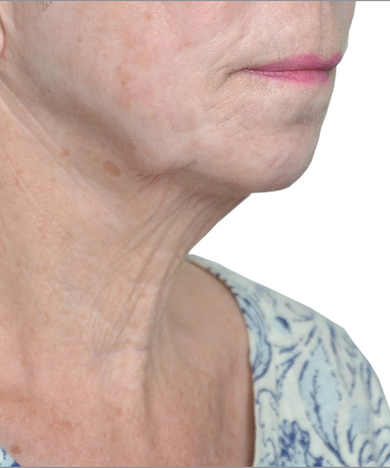 Skin Tightening Before & After