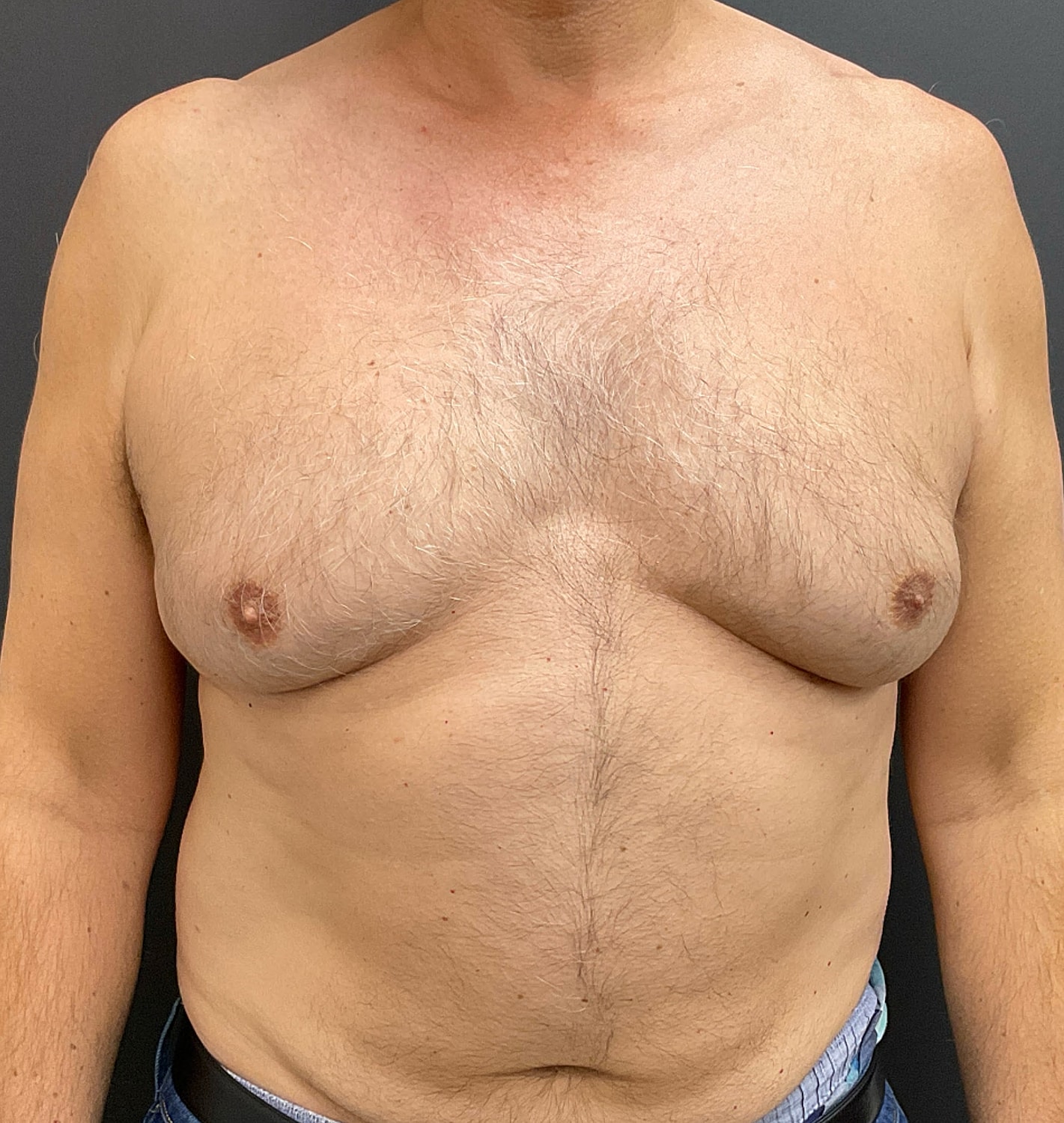 Gynecomastia Before & After