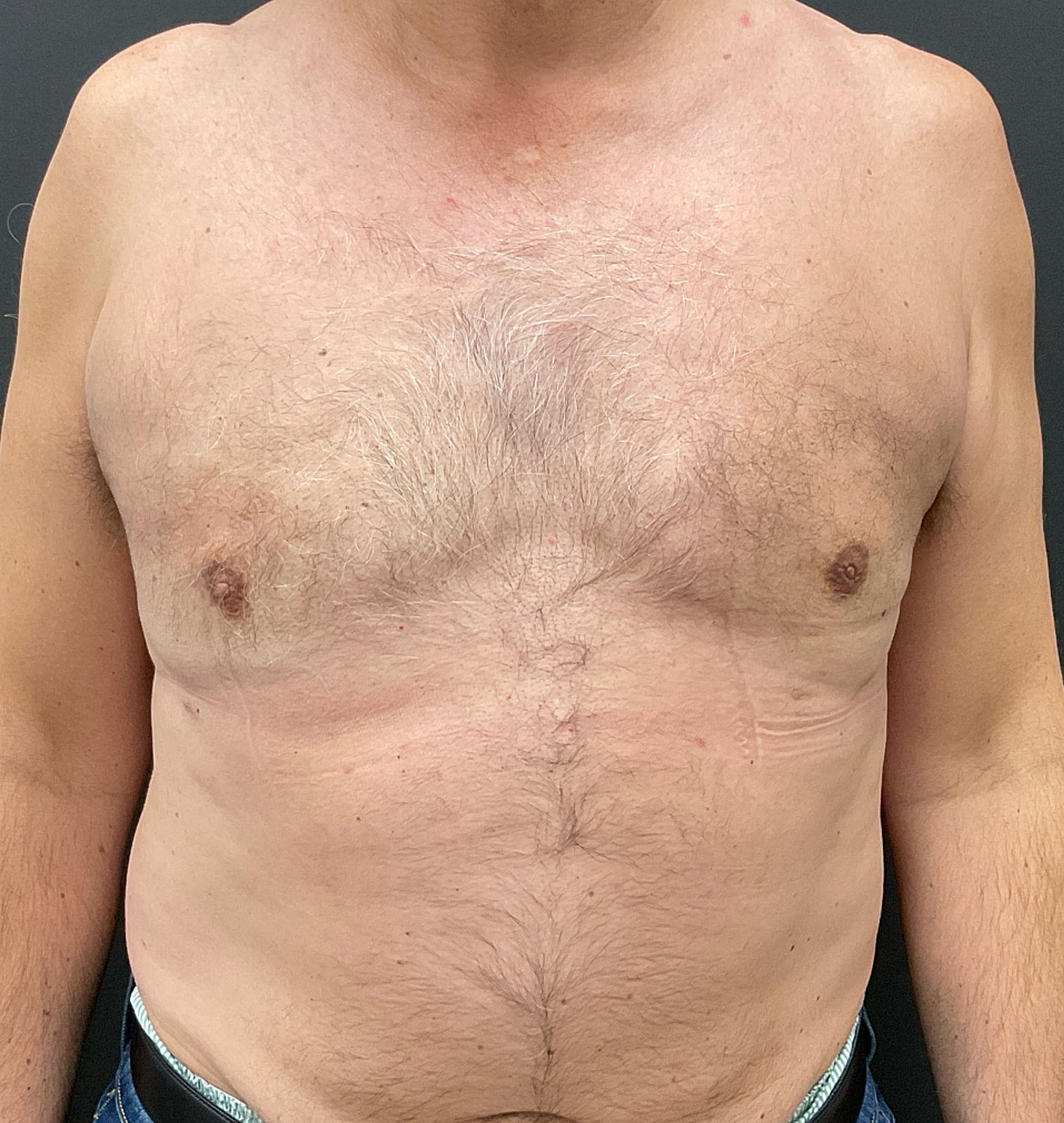 Gynecomastia Before & After