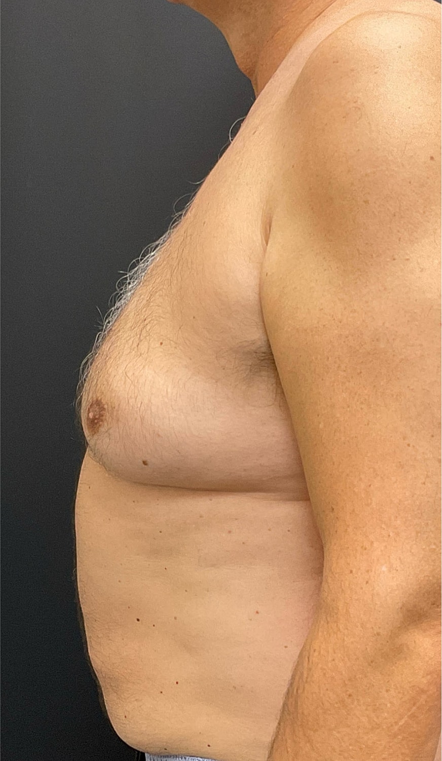 Gynecomastia Before & After