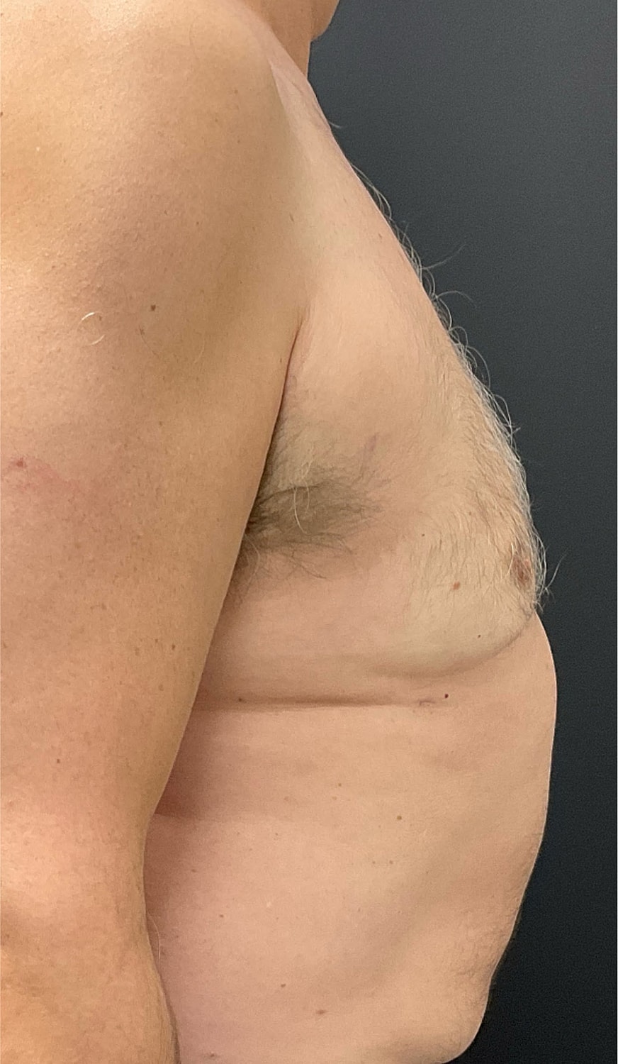 Gynecomastia Before & After