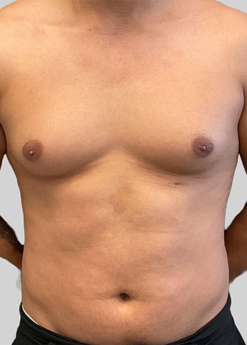Gynecomastia Before & After