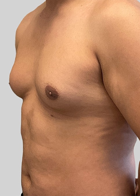 Gynecomastia Before & After