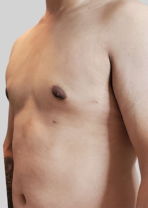 Gynecomastia Before & After