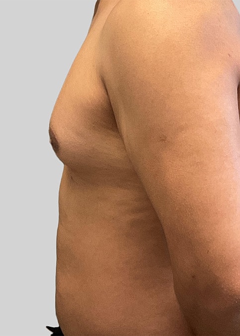 Gynecomastia Before & After