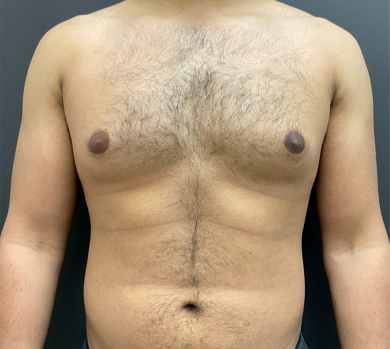 Gynecomastia Before & After