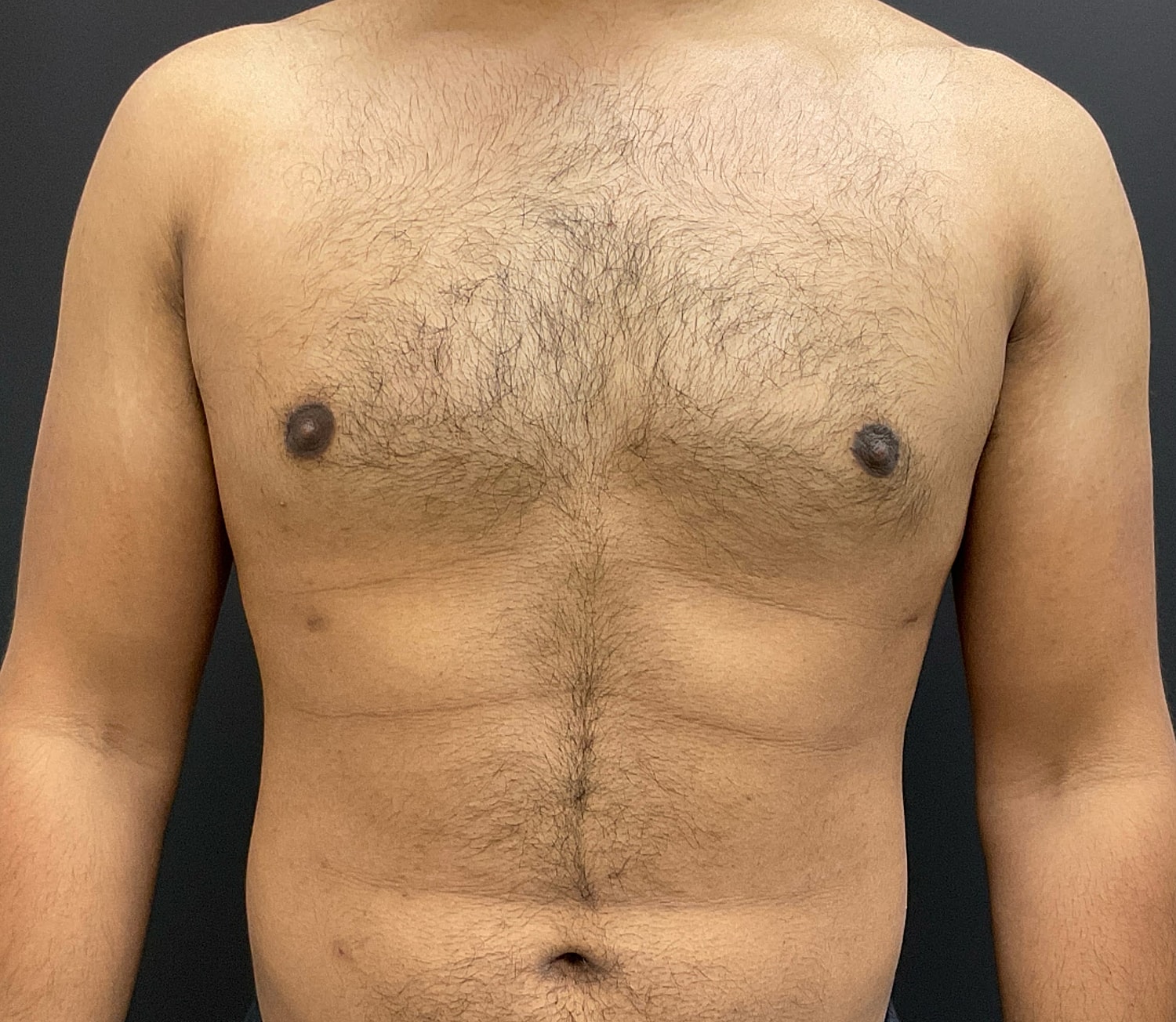 Gynecomastia Before & After