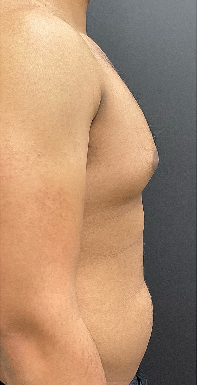 Gynecomastia Before & After