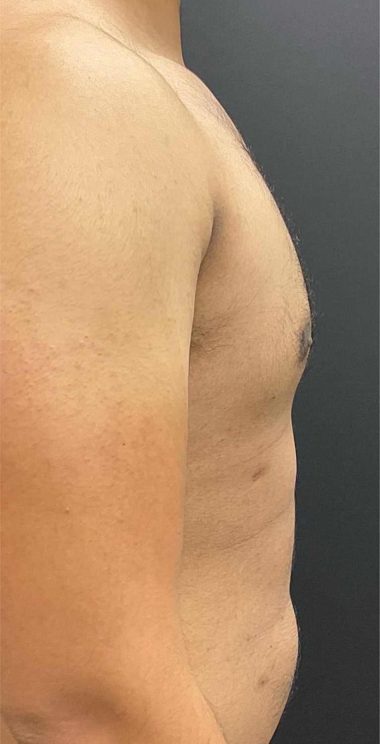 Gynecomastia Before & After