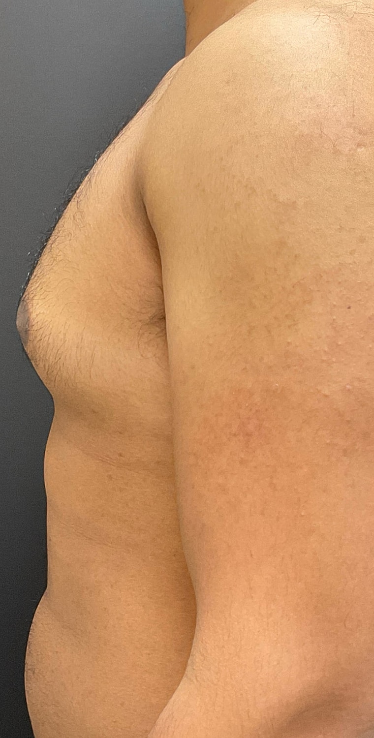 Gynecomastia Before & After