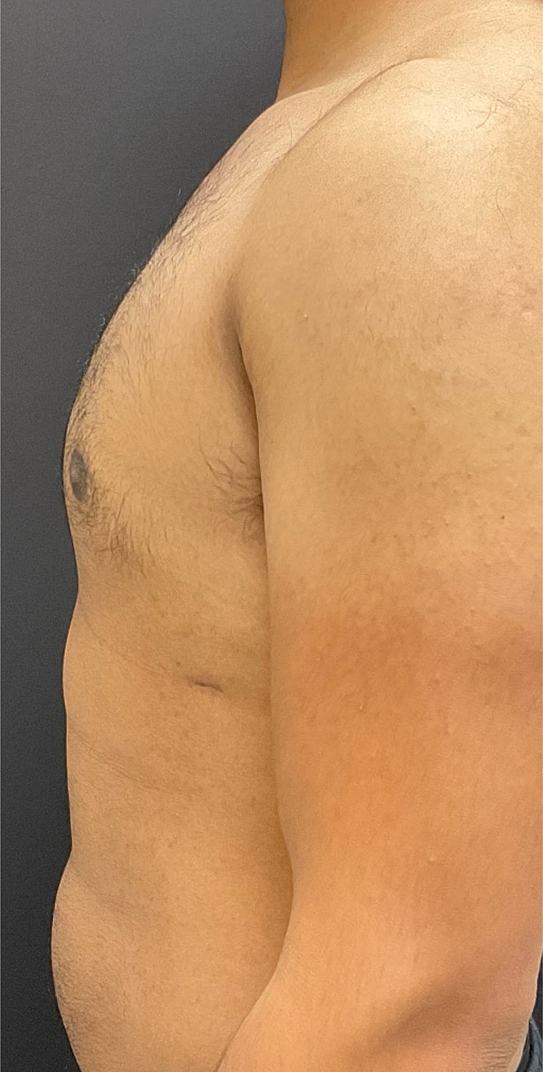 Gynecomastia Before & After