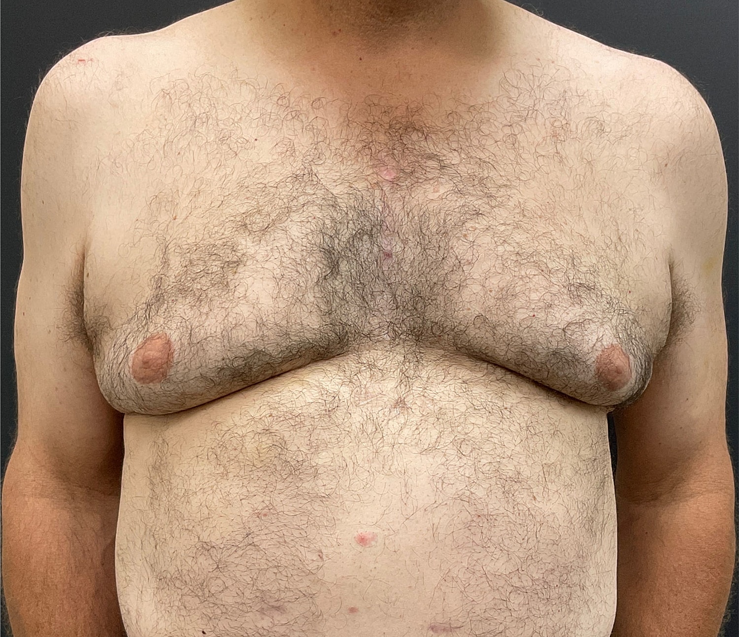 Gynecomastia Before & After