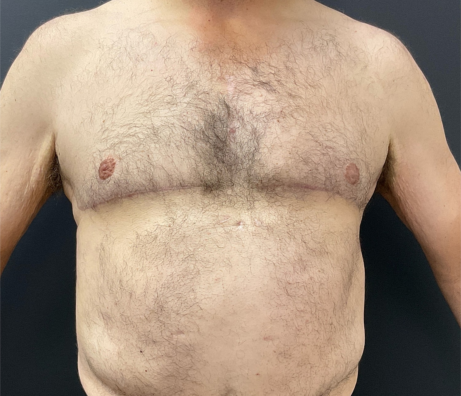 Gynecomastia Before & After