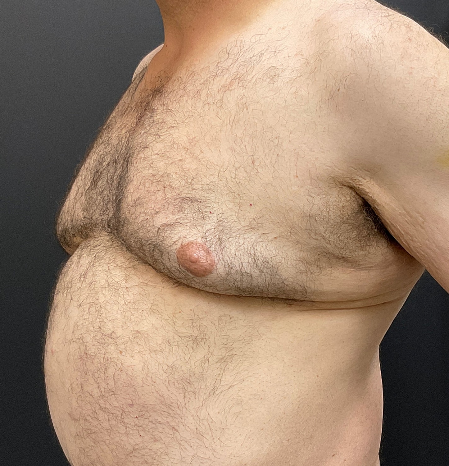 Gynecomastia Before & After