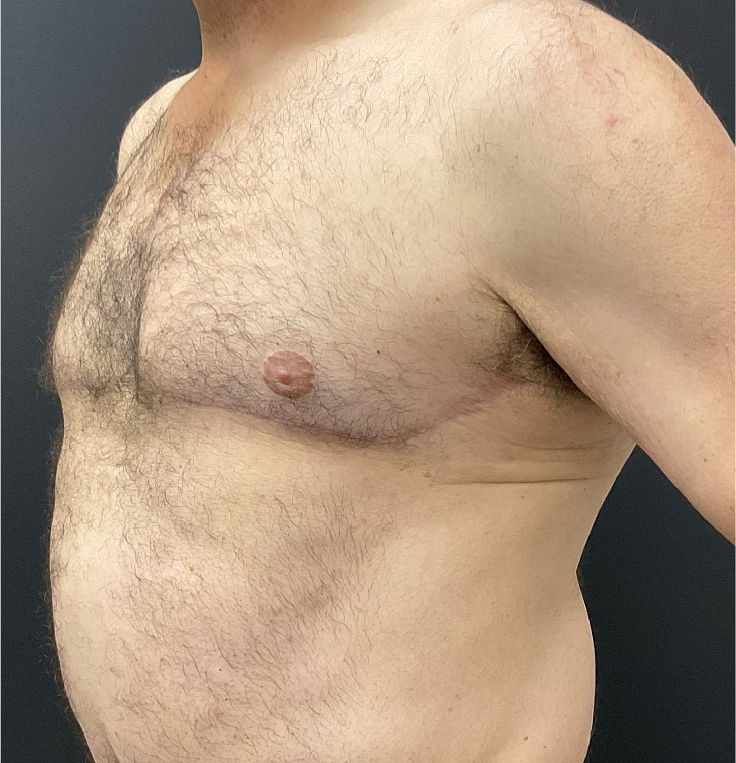 Gynecomastia Before & After