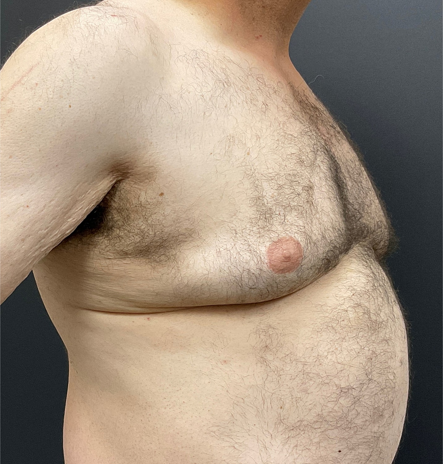 Gynecomastia Before & After