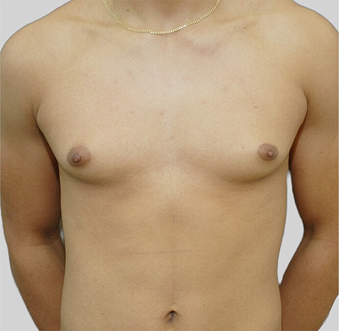 Gynecomastia Before & After