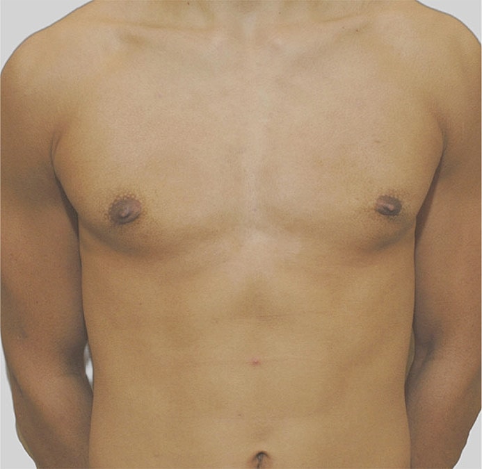 Gynecomastia Before & After