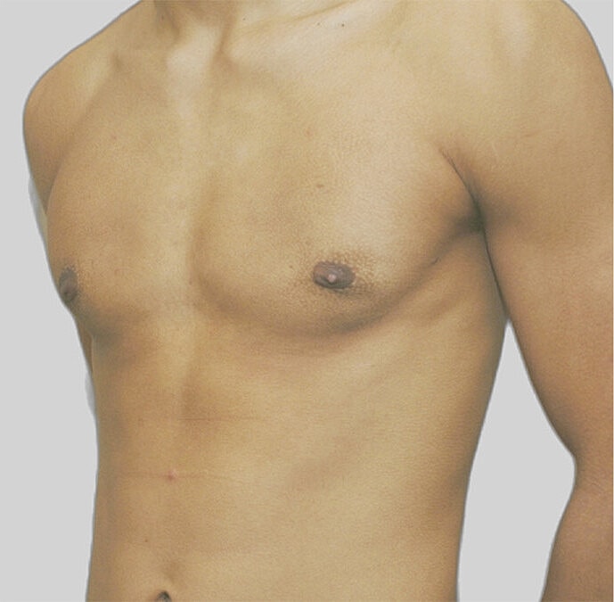 Gynecomastia Before & After