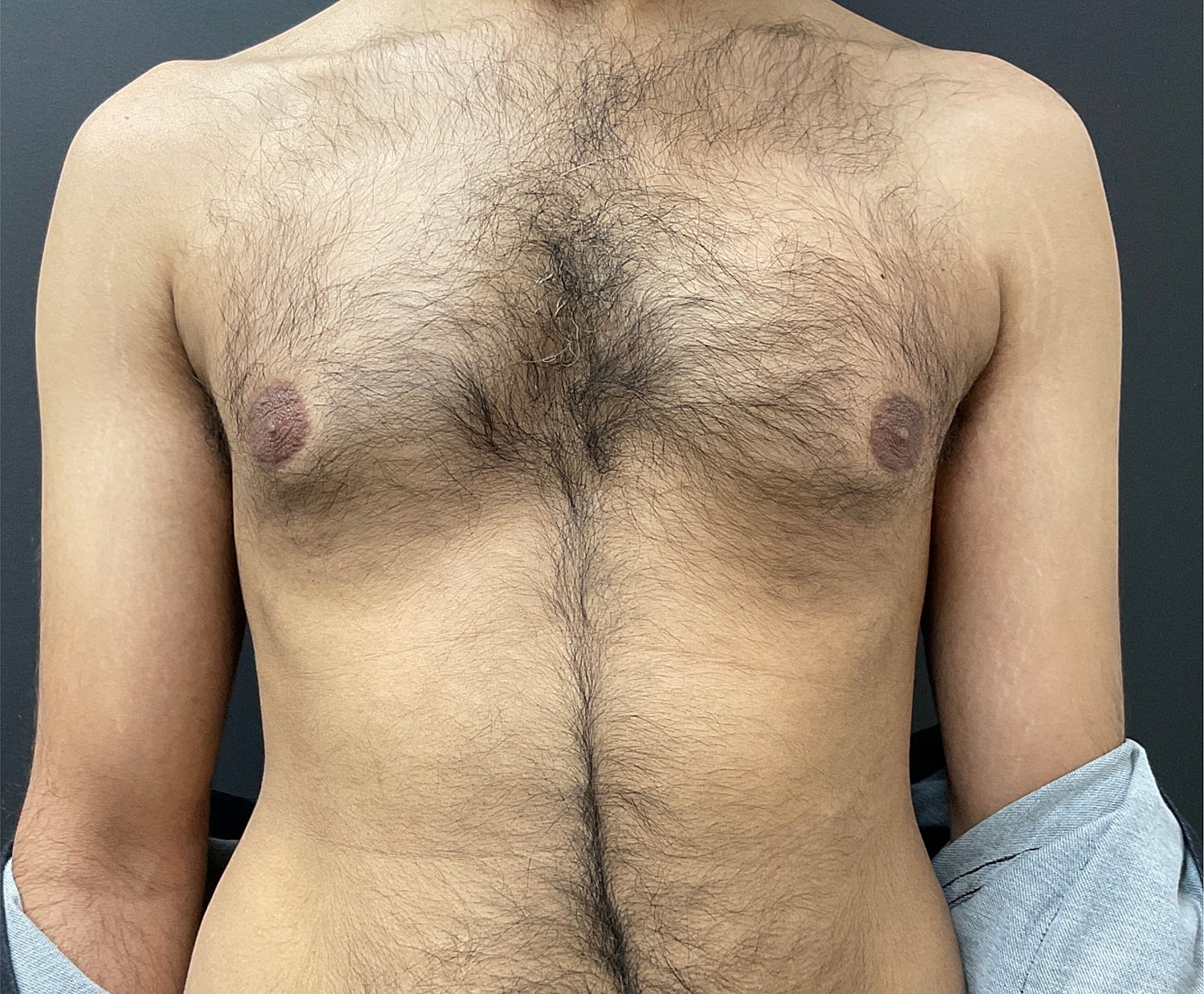Gynecomastia Before & After