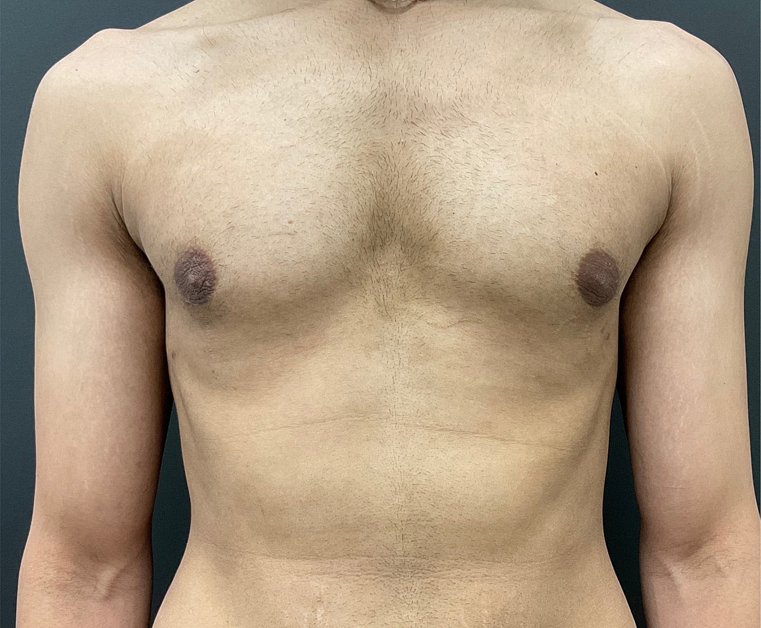 Gynecomastia Before & After