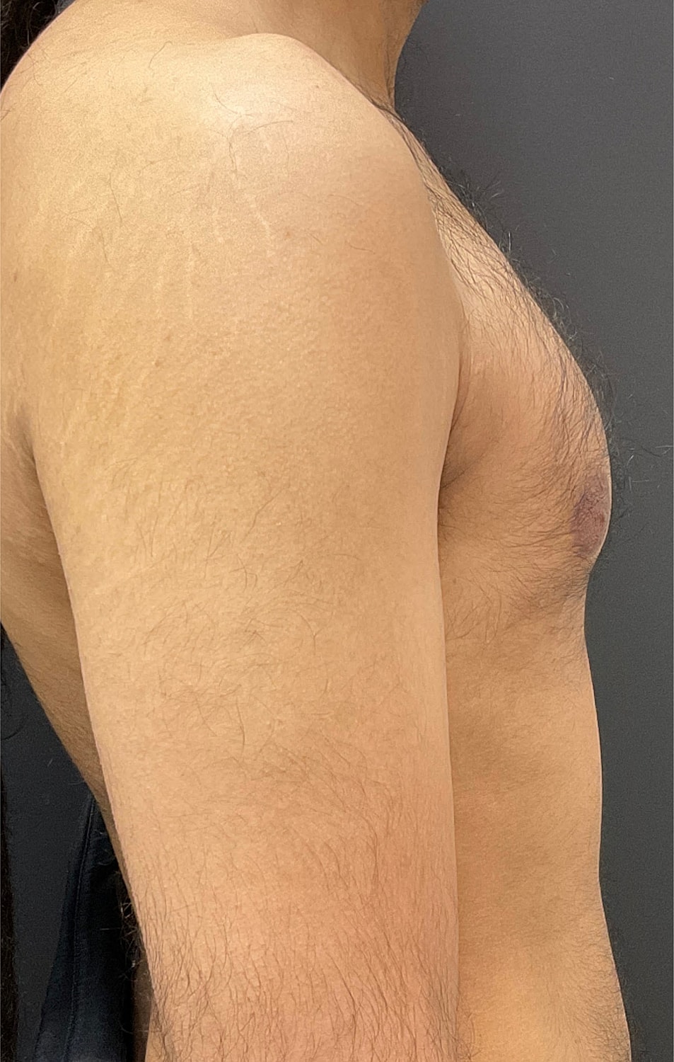 Gynecomastia Before & After