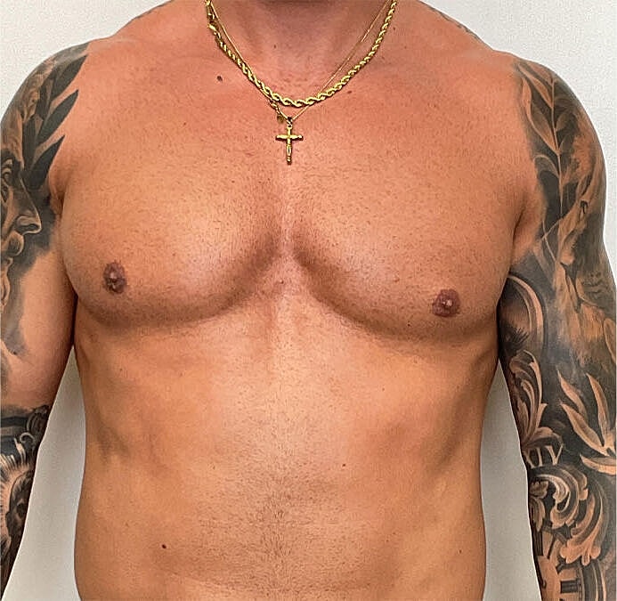 Gynecomastia Before & After