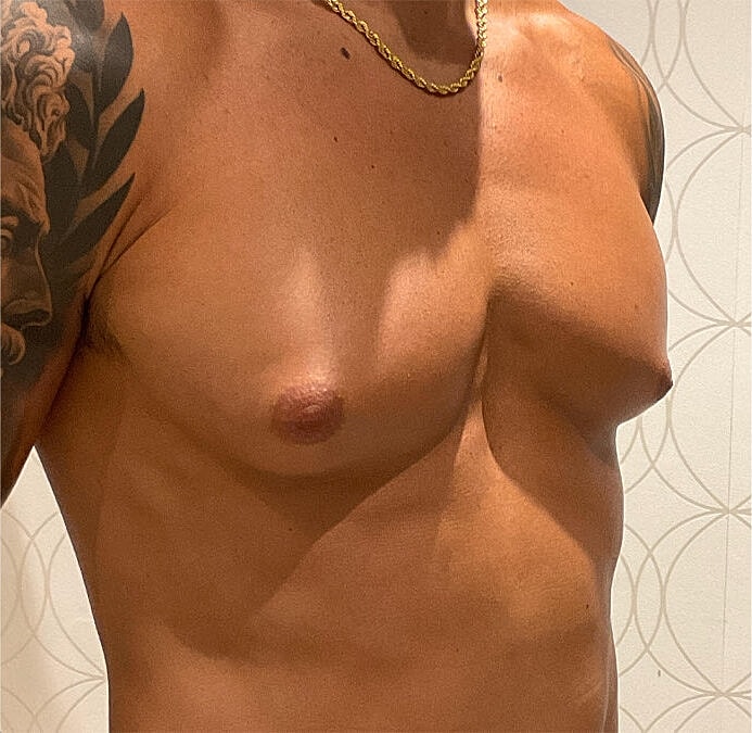 Gynecomastia Before & After