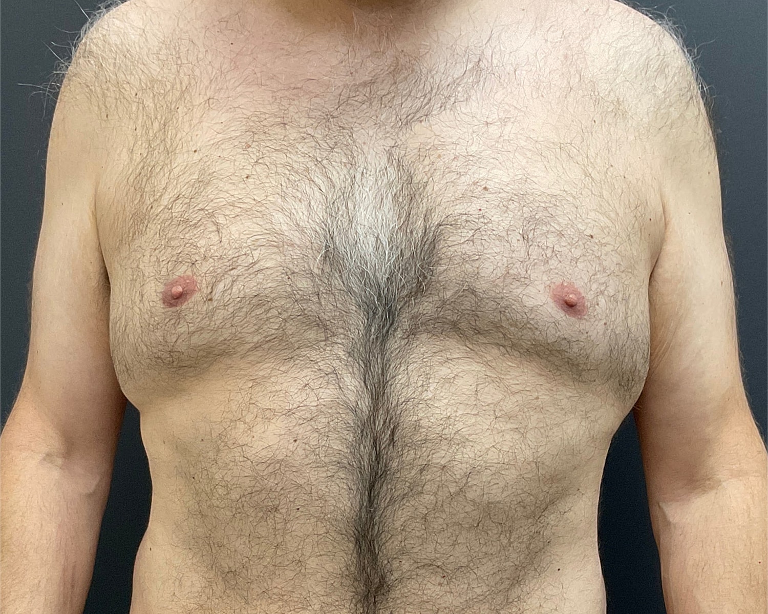 Gynecomastia Before & After