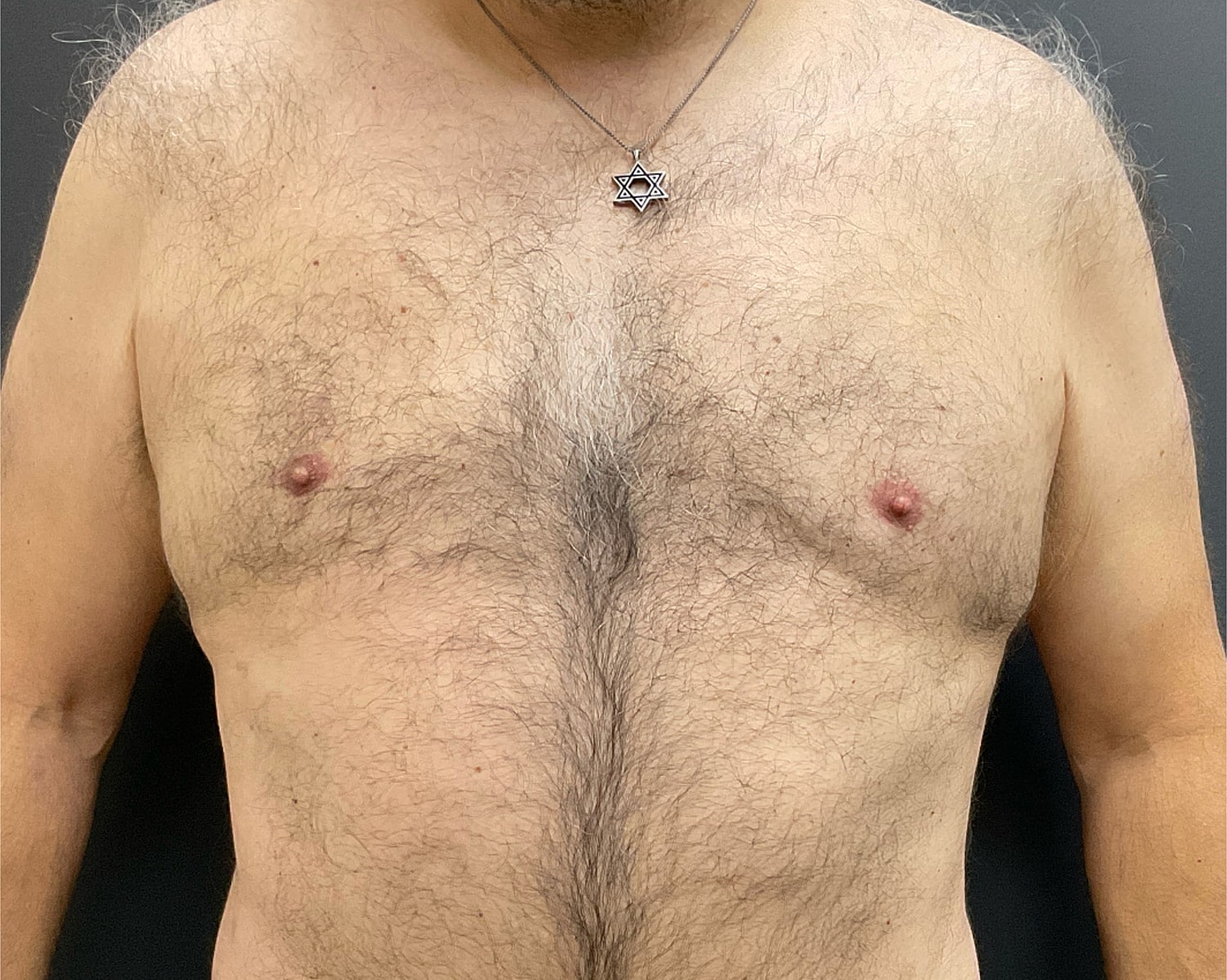 Gynecomastia Before & After