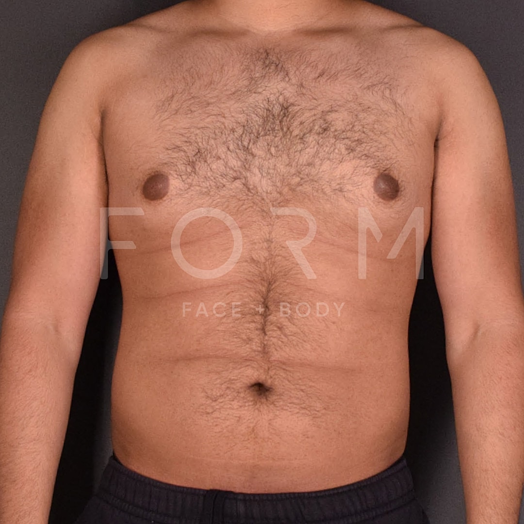 Gynecomastia Before & After