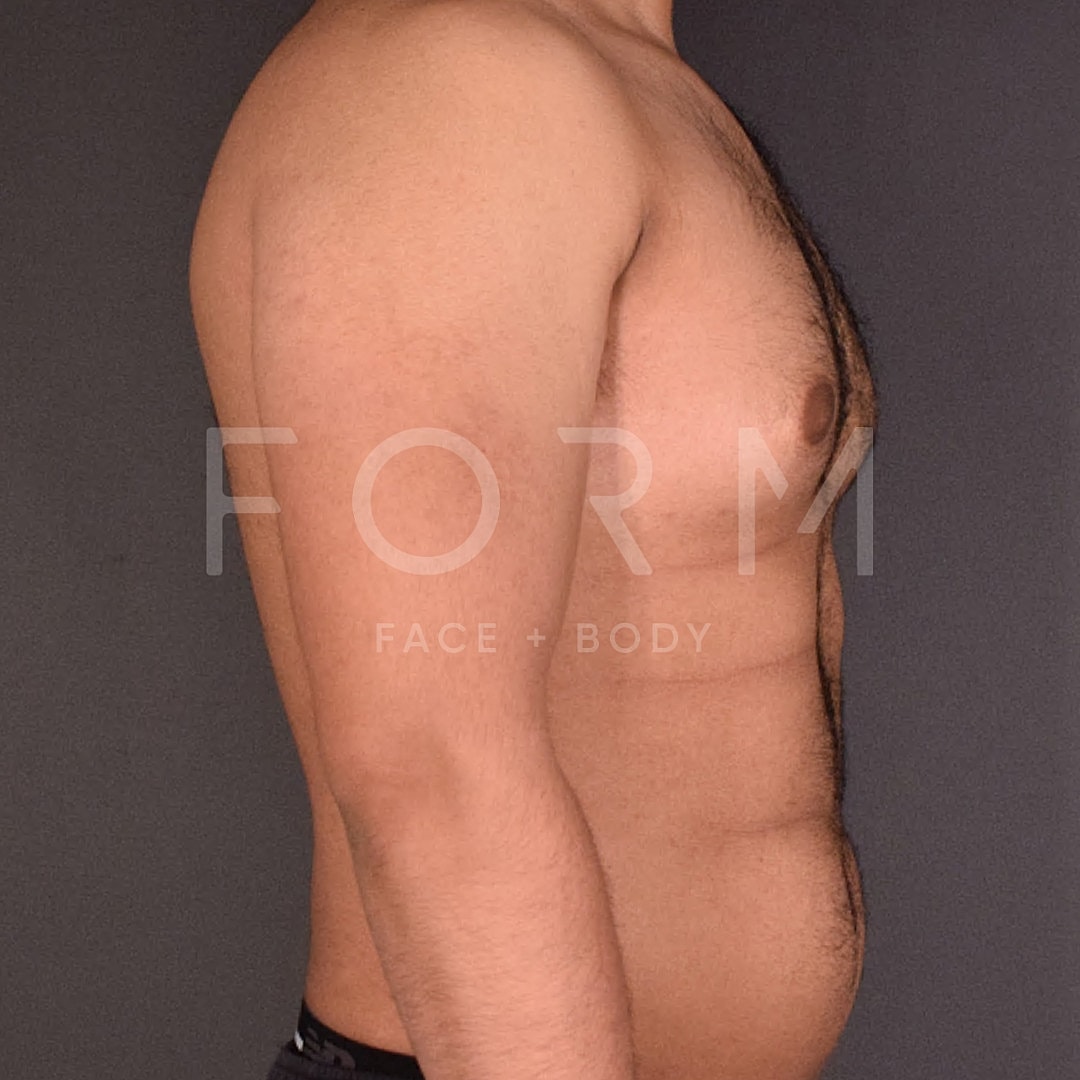 Gynecomastia Before & After