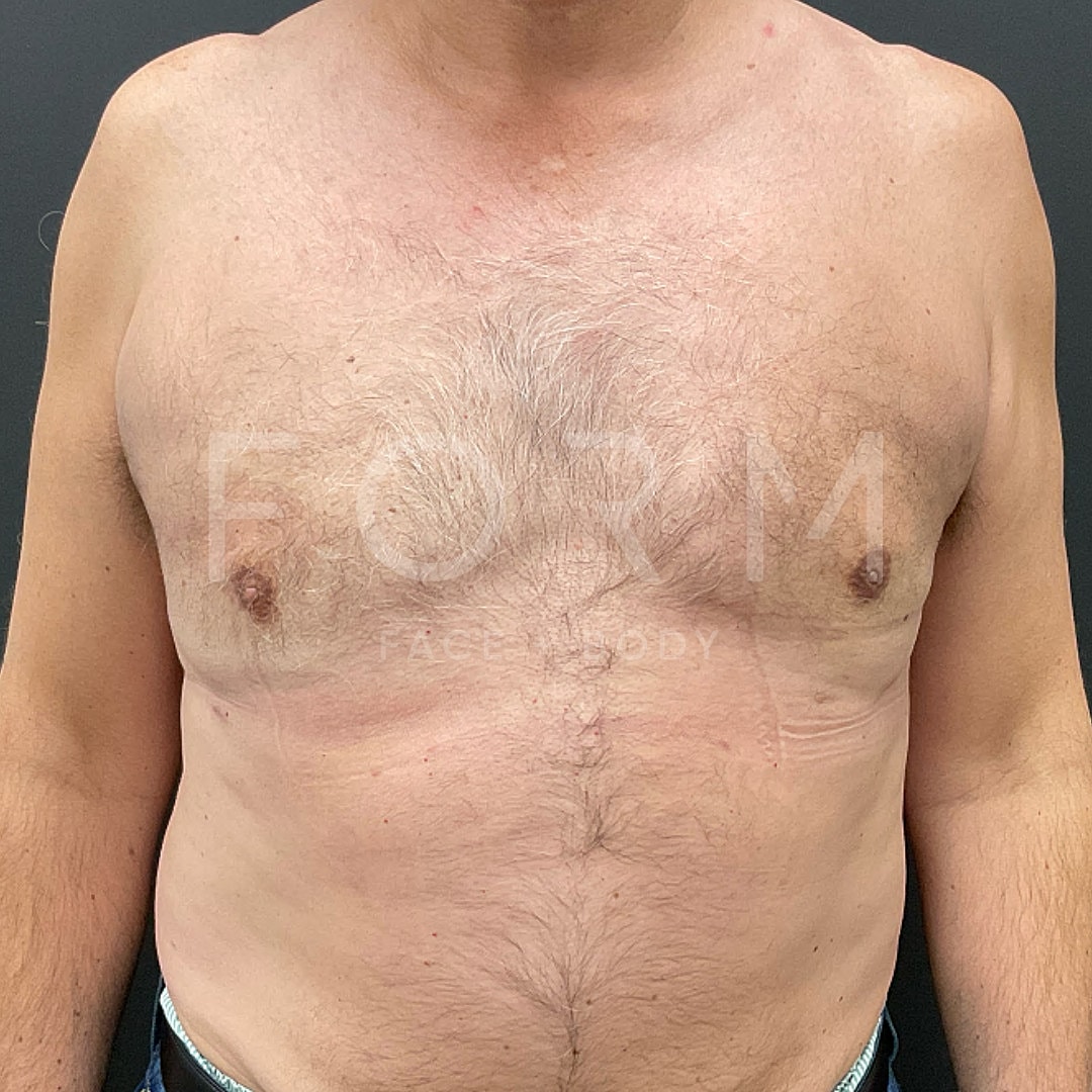 Gynecomastia Before & After