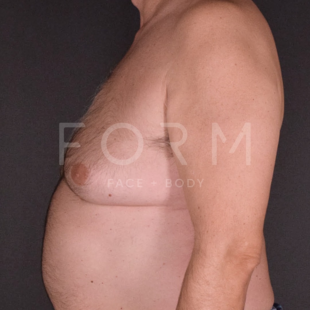 Gynecomastia Before & After